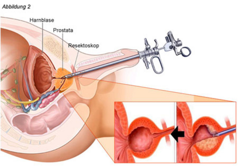 prostatahyperplasie operation