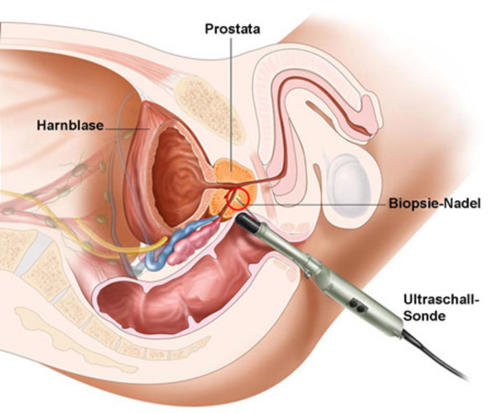 biopsie prostata